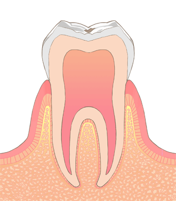 むし歯の進行段階(CO)