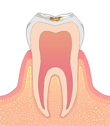 むし歯の進行段階(C1)