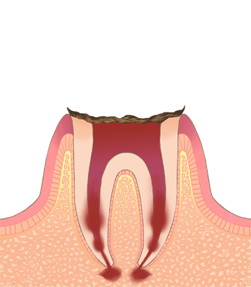 むし歯の進行段階(C4)